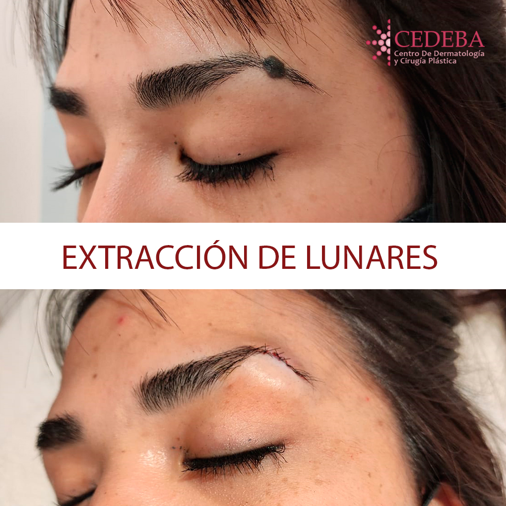 Extracción de lunar en ceja