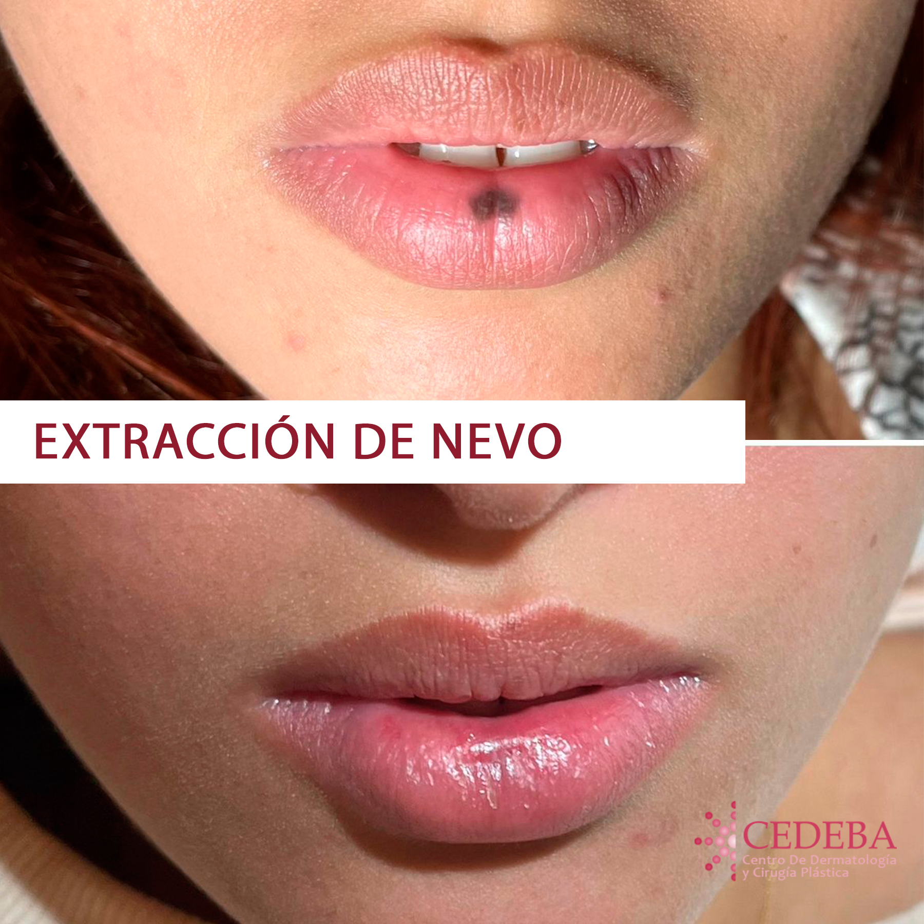 Extracción de nevo en labio