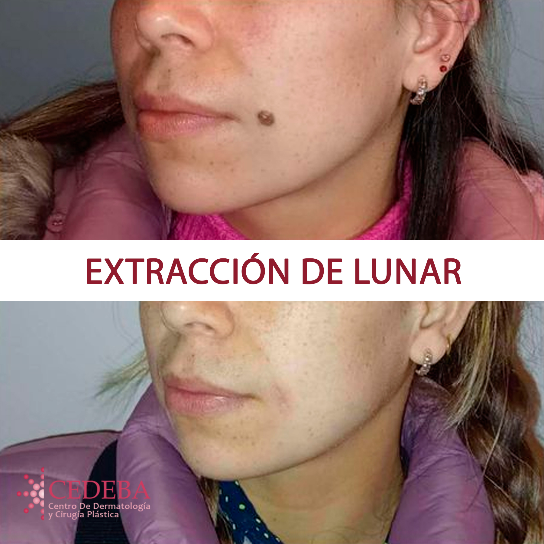 Resultado de extracción de lunar